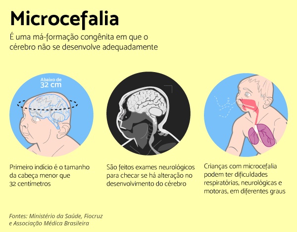 Microcefalia1
