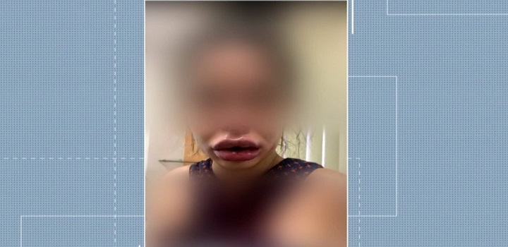 dentista de Campos dos Goytacazes, no Norte Fluminense, está sendo acusada por pacientes de deformar rostos após procedimentos de harmonização facial