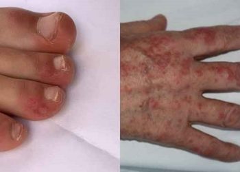 Em estudo do King's College London, no Reino Unido, 21% das pessoas disseram que sinais dermatológicos foram os únicos sinais clínicos da covid-19