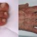 Em estudo do King's College London, no Reino Unido, 21% das pessoas disseram que sinais dermatológicos foram os únicos sinais clínicos da covid-19