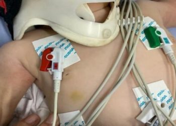 Na unidade, após perceber pelo menos 30 hematomas aparentes pelo corpo da bebê, a médica suspeitou que a criança fosse vítima de maus-tratos e acionou as autoridades.