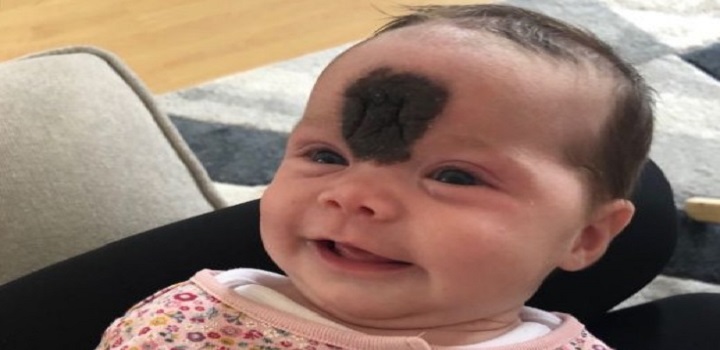 Bebê marca de nascença