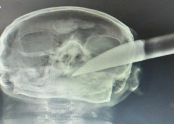 Um homem de 59 anos teve um facão cravado na cabeça após uma briga com um conhecido dentro da própria casa em Mafra, no Norte catarinense.