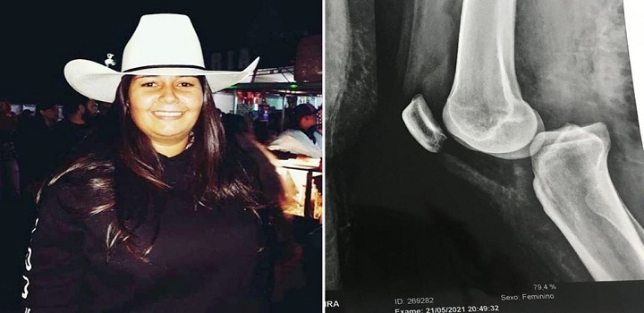 Uma estudante de medicina veterinária, de 27 anos, precisou amputar uma das pernas após ser prensada contra uma cerca por um boi de mais de 600 quilos no sítio em que mora, em Sorocaba