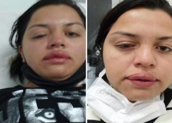 faxineira Francieli Priscila Correa Froelich, de 31 anos, atacada pelo ex-patrão de 70 anos com ácido no rosto,