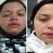 faxineira Francieli Priscila Correa Froelich, de 31 anos, atacada pelo ex-patrão de 70 anos com ácido no rosto,