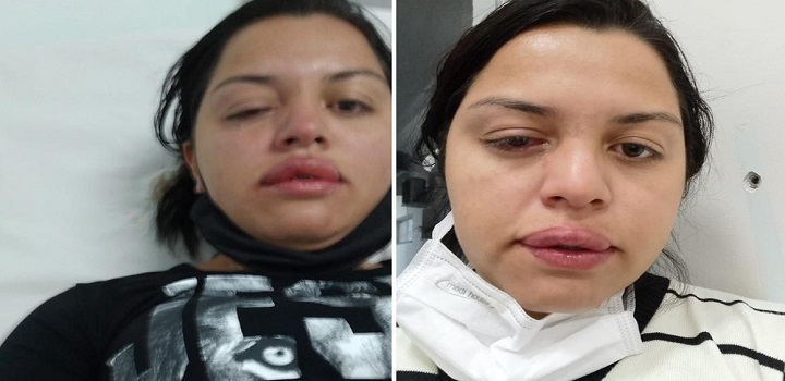 faxineira Francieli Priscila Correa Froelich, de 31 anos, atacada pelo ex-patrão de 70 anos com ácido no rosto,
