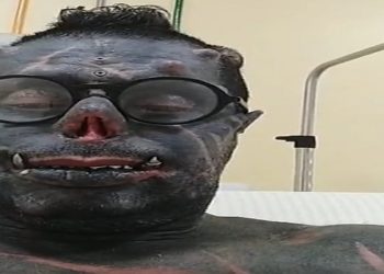 'Diabão' recebe alta no litoral de SP após cirurgia e família agradece