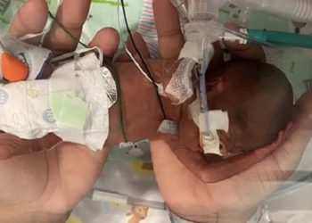 Bebê mais prematuro do mundo