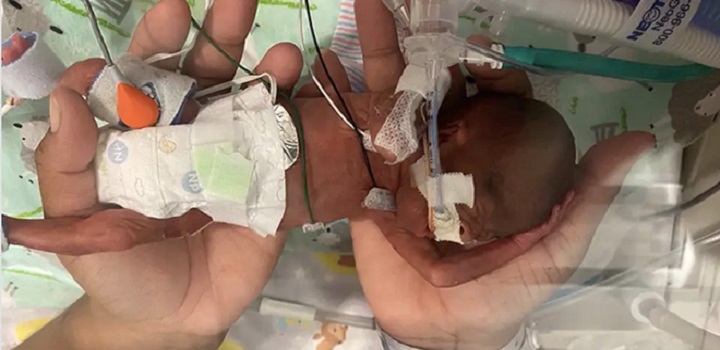 Bebê mais prematuro do mundo