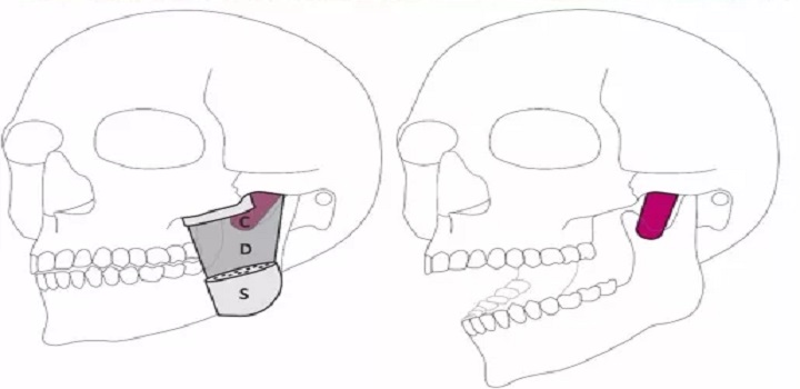 Pesquisadores da Universidade de Basileia identificaram uma camada profunda do músculo masseter que contribui para a estabilização da mandíbula