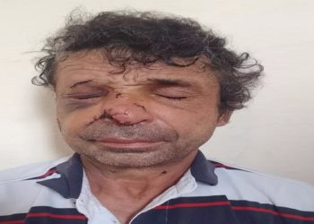 homem de 50 anos perdeu partes do nariz e da orelha ao ser atacado a mordidas por um vizinho