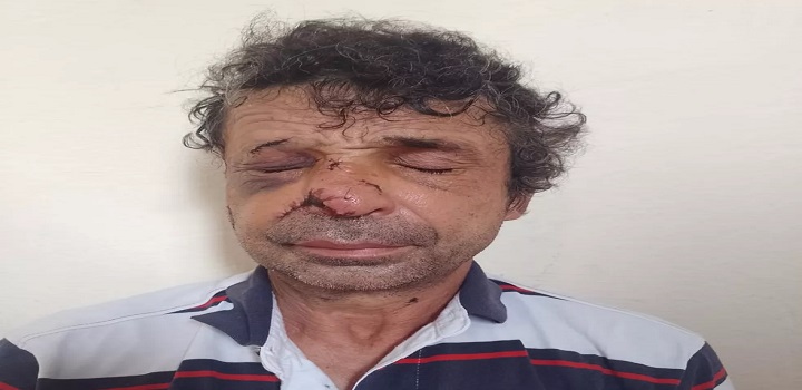 homem de 50 anos perdeu partes do nariz e da orelha ao ser atacado a mordidas por um vizinho