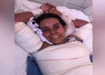 A estudante Annelise Lopes, de 16 anos, que teve 60% do corpo queimado durante uma experiência na escola