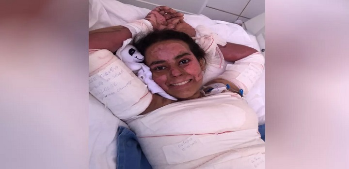 A estudante Annelise Lopes, de 16 anos, que teve 60% do corpo queimado durante uma experiência na escola
