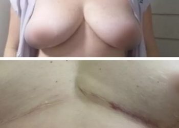 Uma vendedora de 40 anos conta que sofreu com dores intensas e ficou com os seios deformados após cirugia para colocar próteses de silicone, em Goiânia.