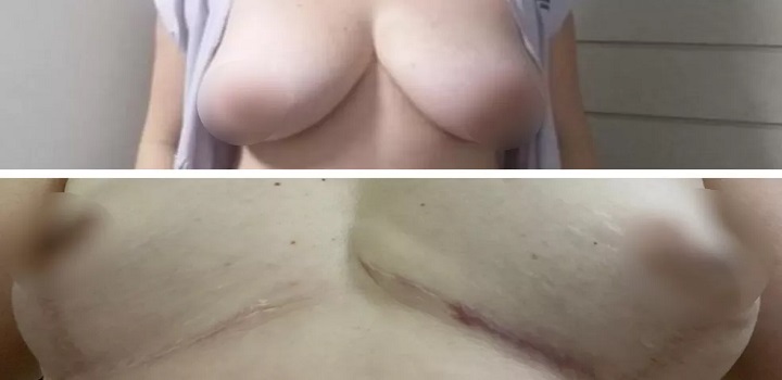 Uma vendedora de 40 anos conta que sofreu com dores intensas e ficou com os seios deformados após cirugia para colocar próteses de silicone, em Goiânia.