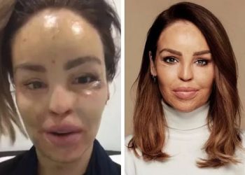 A modelo e apresentadora Katie Piper, 38 anos, explicou como os cirurgiões plásticos do NHS (serviço público de saúde britânico) reconstruíram seu rosto "a partir de uma vaca"