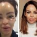 A modelo e apresentadora Katie Piper, 38 anos, explicou como os cirurgiões plásticos do NHS (serviço público de saúde britânico) reconstruíram seu rosto "a partir de uma vaca"