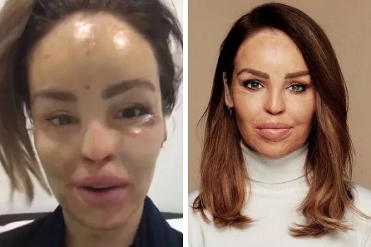 A modelo e apresentadora Katie Piper, 38 anos, explicou como os cirurgiões plásticos do NHS (serviço público de saúde britânico) reconstruíram seu rosto "a partir de uma vaca"