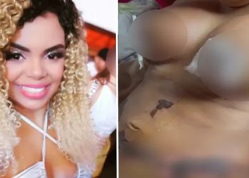 vendedora tem necrose após cirurgia plastica em Goiania