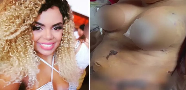 vendedora tem necrose após cirurgia plastica em Goiania