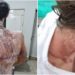 Cerca de 20 alunos apresentam queimaduras após trote realizado na UFPR