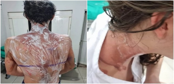 Cerca de 20 alunos apresentam queimaduras após trote realizado na UFPR