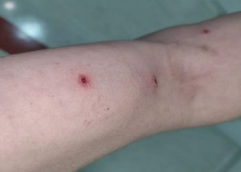 Saiba sobre o primeiro brasileiro diagnosticado com a variola do macaco