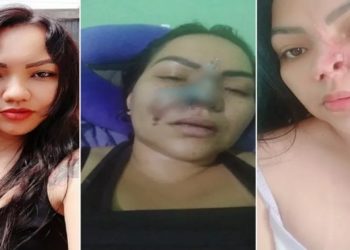Uma mulher de 37 anos denuncia que teve parte do nariz necrosado e ficou com sequelas após um procedimento estético para afinar o nariz com um dentista de Aparecida de Goiânia, Região Metropolitana da capital. Elielma Carvalho Braga