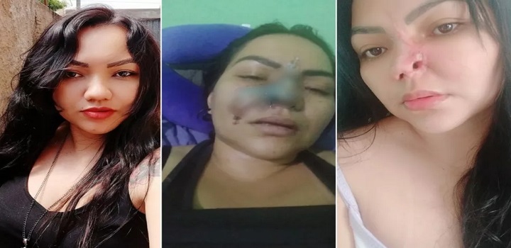 Uma mulher de 37 anos denuncia que teve parte do nariz necrosado e ficou com sequelas após um procedimento estético para afinar o nariz com um dentista de Aparecida de Goiânia, Região Metropolitana da capital. Elielma Carvalho Braga
