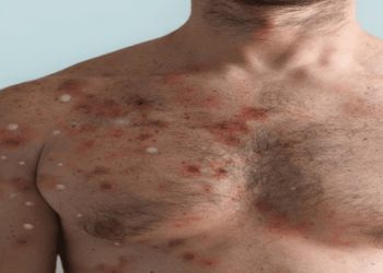 95% dos casos estudados de varíola dos macacos foram transmitidos através de relações sexuais.