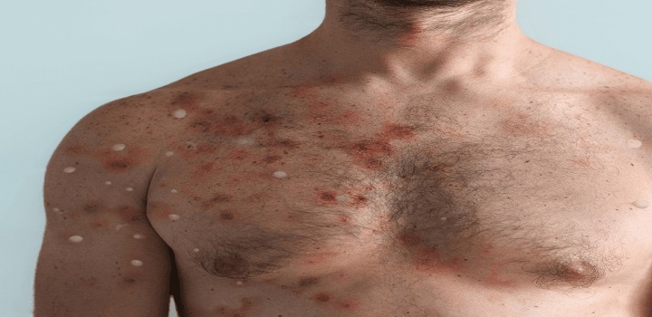 95% dos casos estudados de varíola dos macacos foram transmitidos através de relações sexuais.