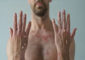 vARIOLA DO MACACO: ESTIGMATIZAÇÃO FAZ LEMBRAR EPIDEMIA DO HIV