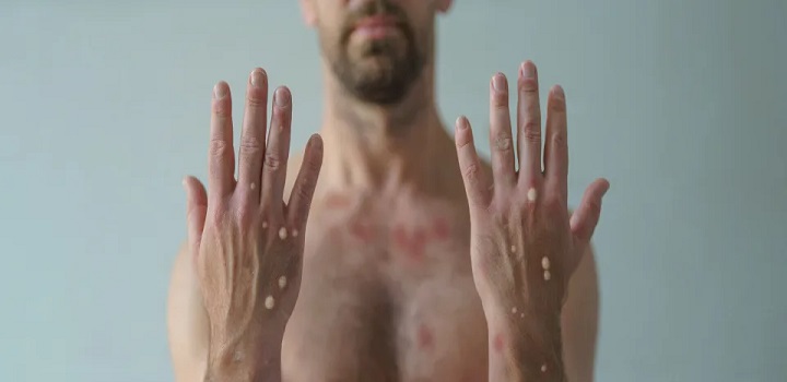 vARIOLA DO MACACO: ESTIGMATIZAÇÃO FAZ LEMBRAR EPIDEMIA DO HIV