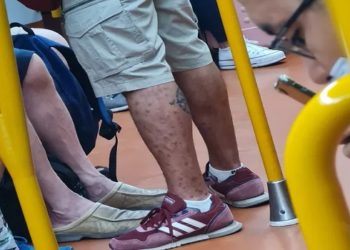 homem com variola do macaco em metro na espanha