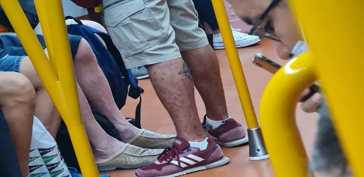 homem com variola do macaco em metro na espanha
