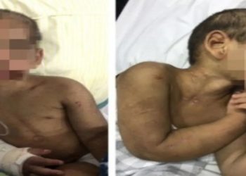 criança tem costelas fraturadas por mãe e padrasto