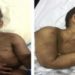 criança tem costelas fraturadas por mãe e padrasto