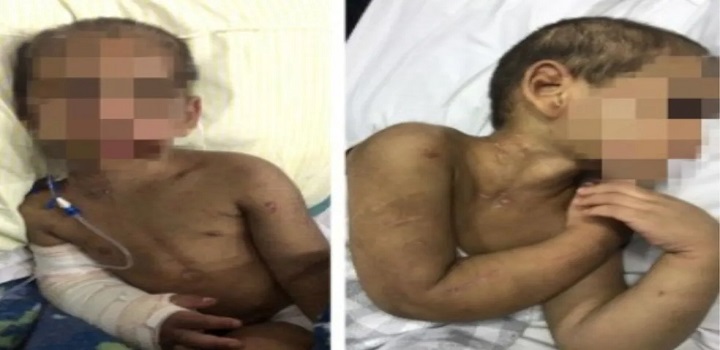 criança tem costelas fraturadas por mãe e padrasto