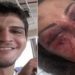 Vinicius e o rosto de Elaine após a agressão: ela sente dore até hoje — Foto: Reprodução/Instagram