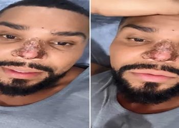 nariz do cantor naldo benny, procedimento rinoplastia