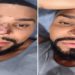 nariz do cantor naldo benny, procedimento rinoplastia