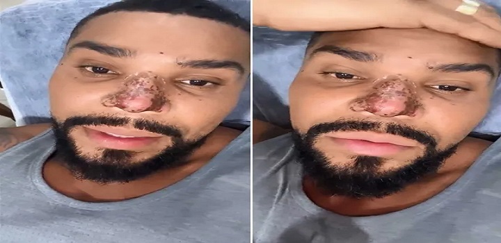 nariz do cantor naldo benny, procedimento rinoplastia