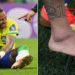 lesão de neymar