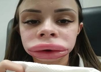 Jovem faz preenchimento labial e descobre doença rara após inchaço incomum