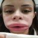 Jovem faz preenchimento labial e descobre doença rara após inchaço incomum