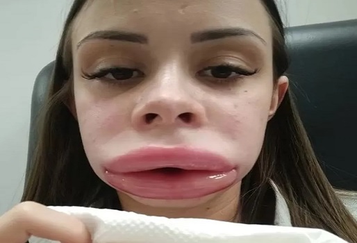 Jovem faz preenchimento labial e descobre doença rara após inchaço incomum