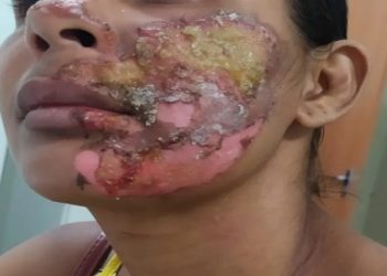 Mulher sofre queimaduras no rosto após ser atacada com óleo quente na BA; companheiro suspeito está preso