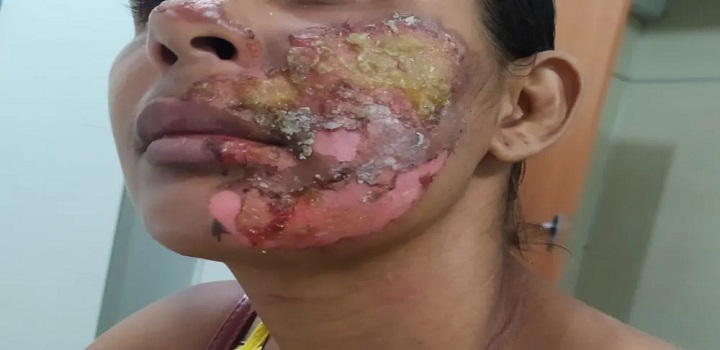 Mulher sofre queimaduras no rosto após ser atacada com óleo quente na BA; companheiro suspeito está preso